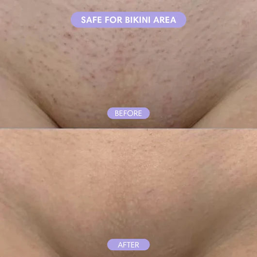 Hair Removal Mousse