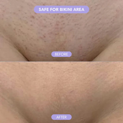 Hair Removal Mousse